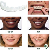 Perfect-Smile Boven & Onder
