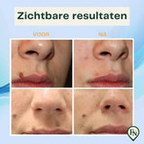 Spot VerwijderingsPen