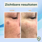 Spot VerwijderingsPen